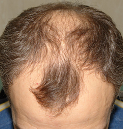 Финастерид для роста бороды