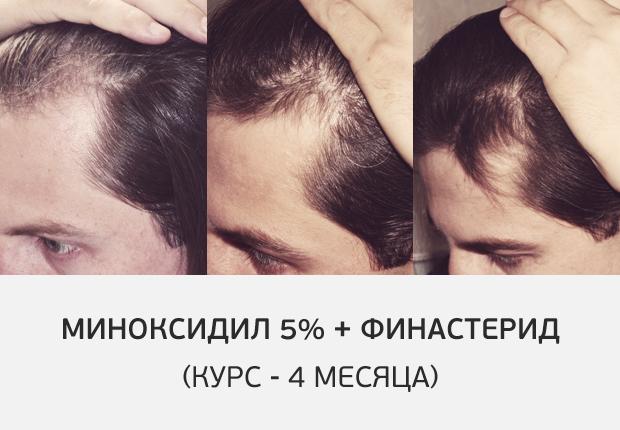Облысение и выпадение волос - интернет-магазин средств для роста волос:  лечение облысения и кожи головы – triholog.ru